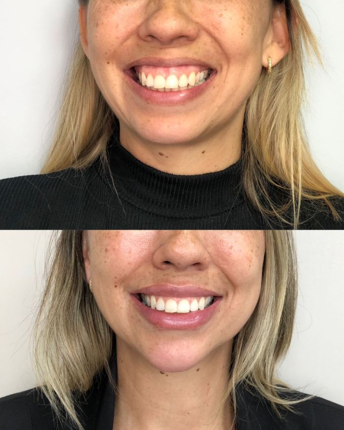 Botox Em Novo Hamburgo Labios Gengiva Queixo