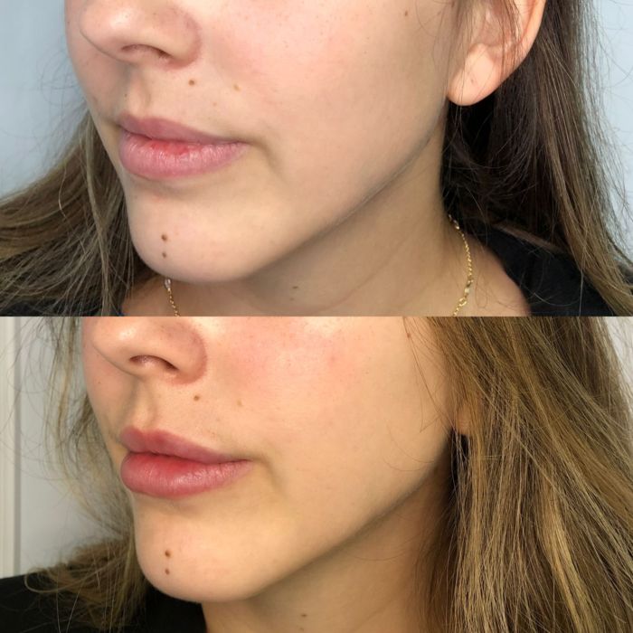 Botox Em Novo Hamburgo Preenchimento De Labios