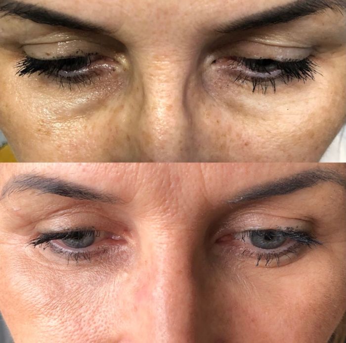 Botox Em Novo Hamburgo Preenchimento De Olheira