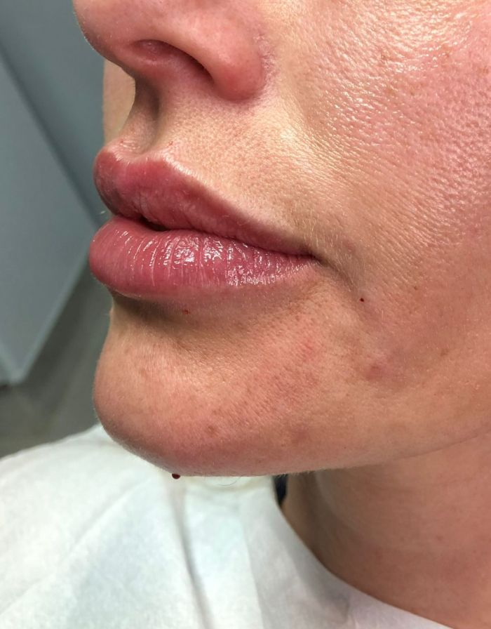 Botox Em Novo Hamburgo Preenchimento Labial Labios
